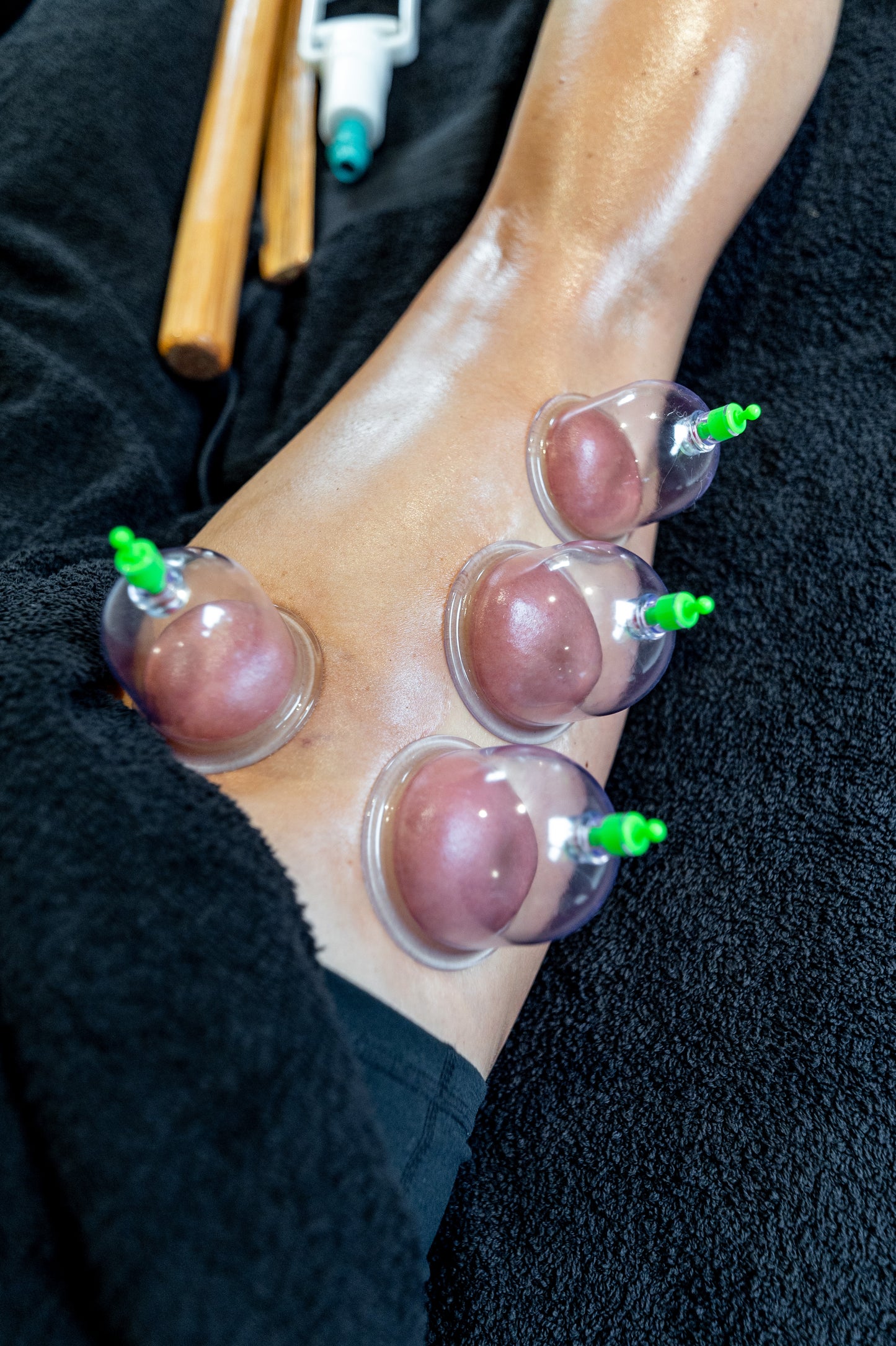 Cupping Massage: Fourways Only